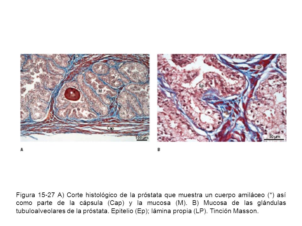 Figura A) Corte histológico de la próstata que muestra un cuerpo amiláceo (*) así como parte de la cápsula (Cap) y la mucosa (M).