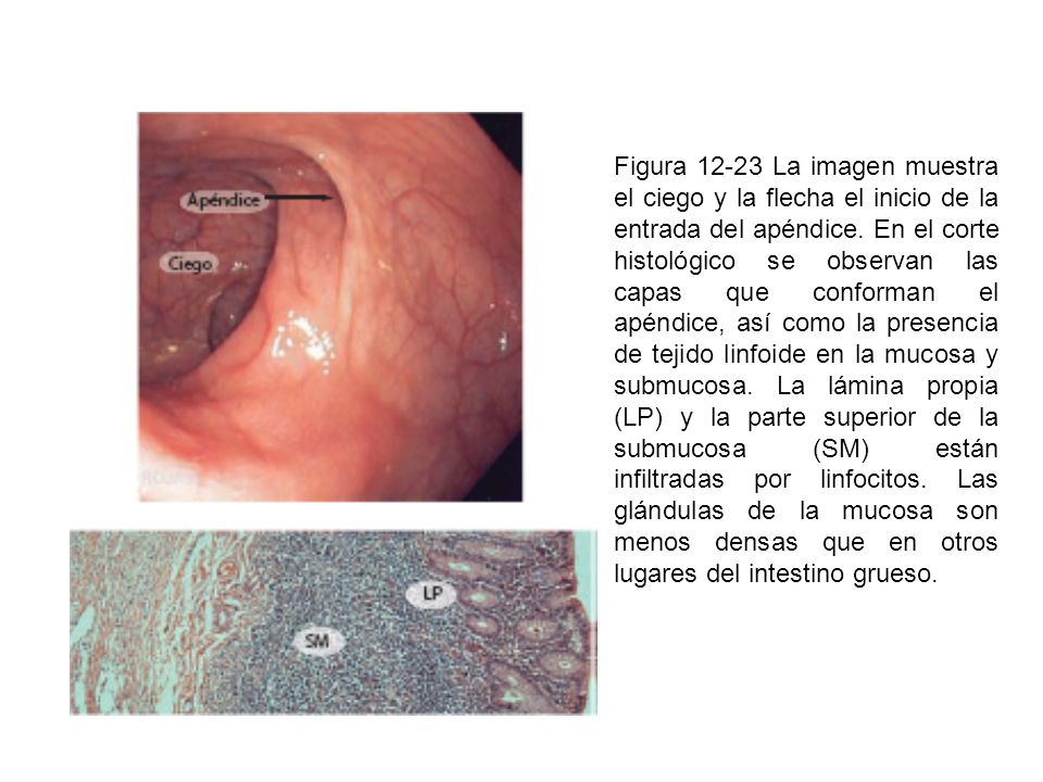 Figura La imagen muestra el ciego y la flecha el inicio de la entrada del apéndice.