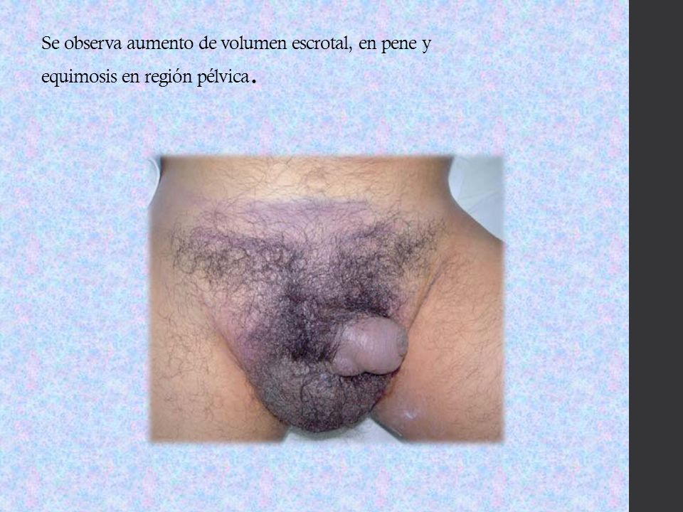 Se observa aumento de volumen escrotal, en pene y equimosis en región pélvica.