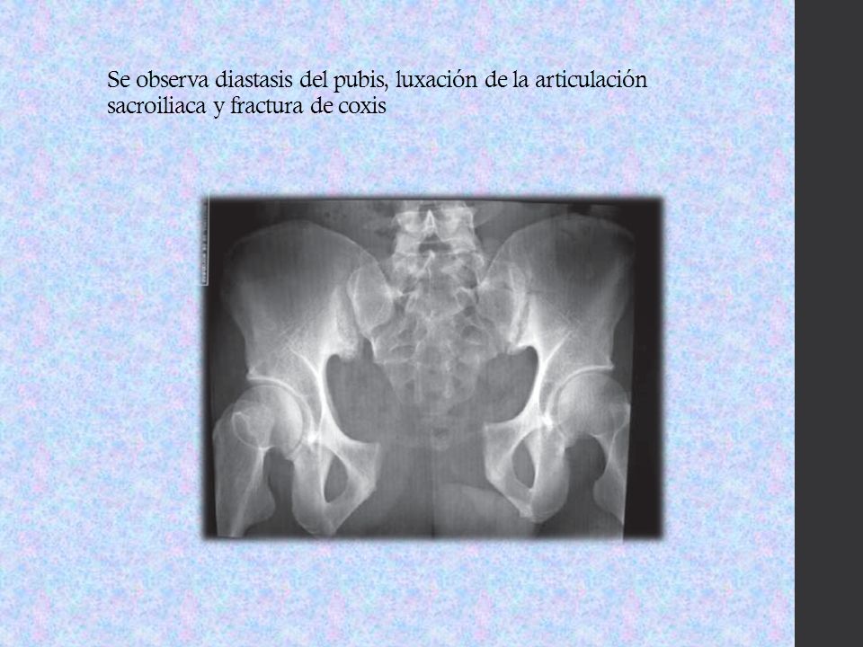 Se observa diastasis del pubis, luxación de la articulación sacroiliaca y fractura de coxis