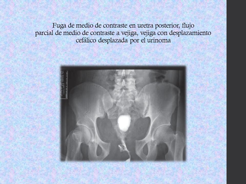 Fuga de medio de contraste en uretra posterior, flujo parcial de medio de contraste a vejiga, vejiga con desplazamiento cefálico desplazada por el urinoma