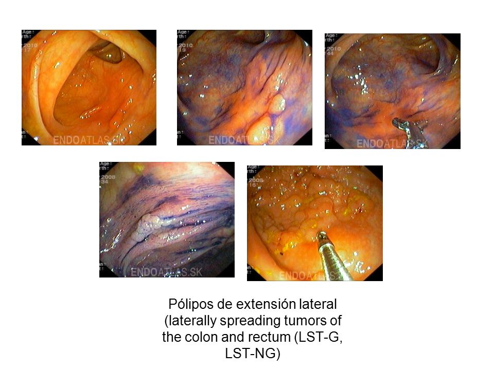 Pólipos de extensión lateral (laterally spreading tumors of the colon and rectum (LST-G, LST-NG)