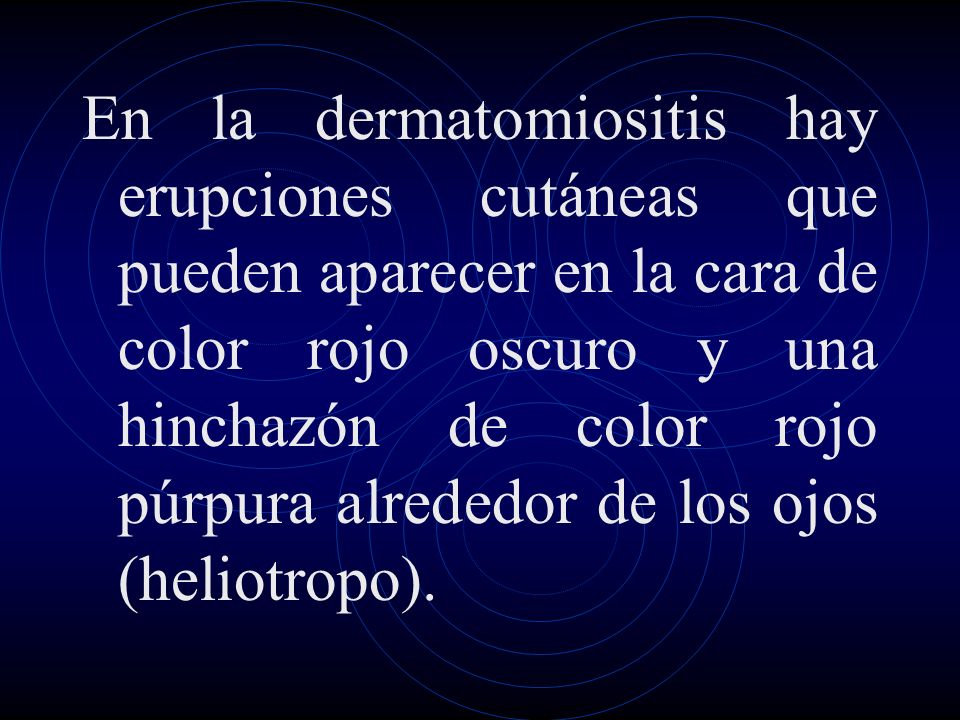 En la dermatomiositis hay erupciones cutáneas que pueden aparecer en la cara de color rojo oscuro y una hinchazón de color rojo púrpura alrededor de los ojos (heliotropo).