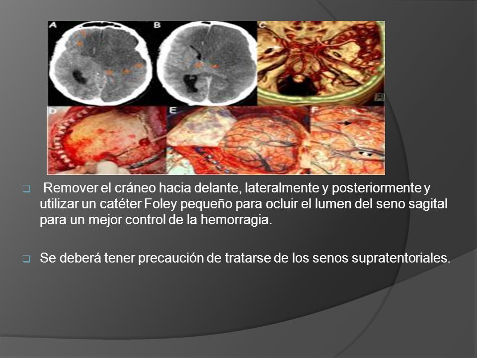Remover el cráneo hacia delante, lateralmente y posteriormente y utilizar un catéter Foley pequeño para ocluir el lumen del seno sagital para un mejor control de la hemorragia.