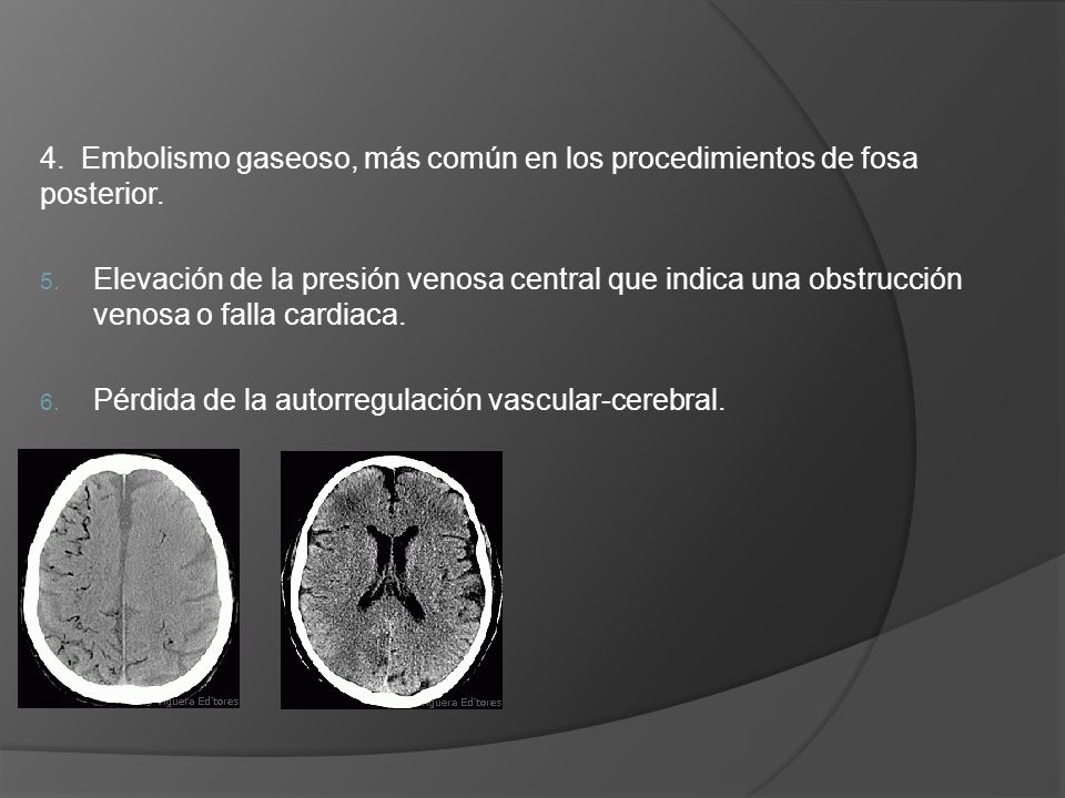 4. Embolismo gaseoso, más común en los procedimientos de fosa posterior.
