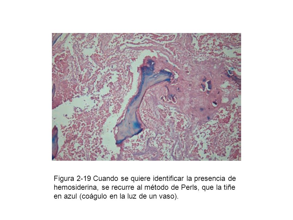 Figura 2-19 Cuando se quiere identificar la presencia de hemosiderina, se recurre al método de Perls, que la tiñe en azul (coágulo en la luz de un vaso).