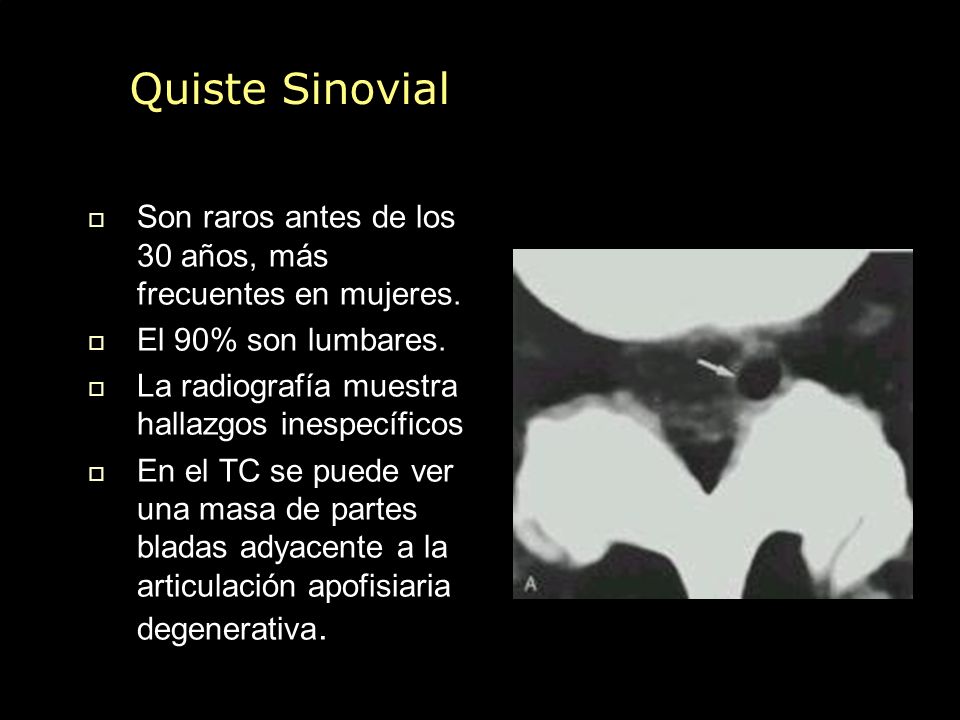 Quiste Sinovial Son raros antes de los 30 años, más frecuentes en mujeres. El 90% son lumbares. La radiografía muestra hallazgos inespecíficos.