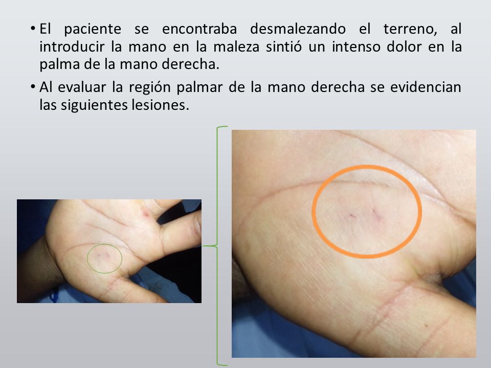 El paciente se encontraba desmalezando el terreno, al introducir la mano en la maleza sintió un intenso dolor en la palma de la mano derecha.