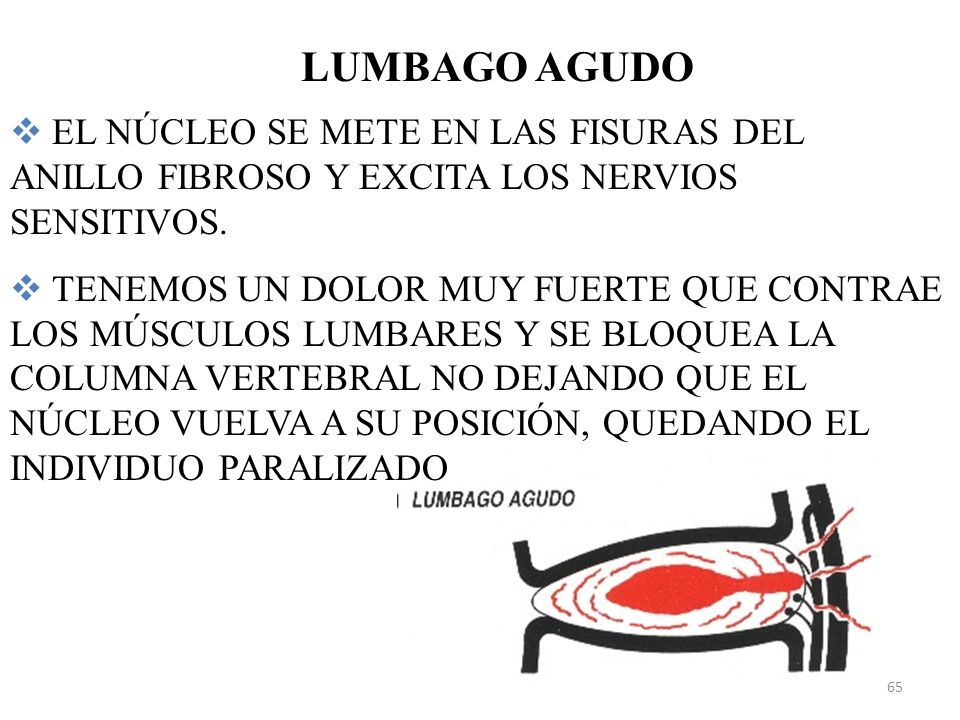 LUMBAGO AGUDO EL NÚCLEO SE METE EN LAS FISURAS DEL ANILLO FIBROSO Y EXCITA LOS NERVIOS SENSITIVOS.