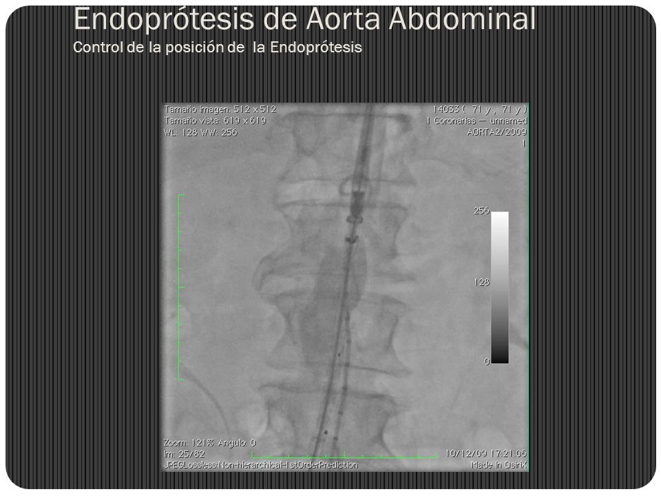 Endoprótesis de Aorta Abdominal Control de la posición de la Endoprótesis