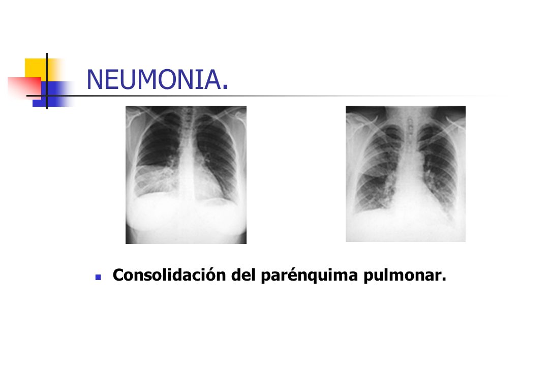 NEUMONIA. Consolidación del parénquima pulmonar.