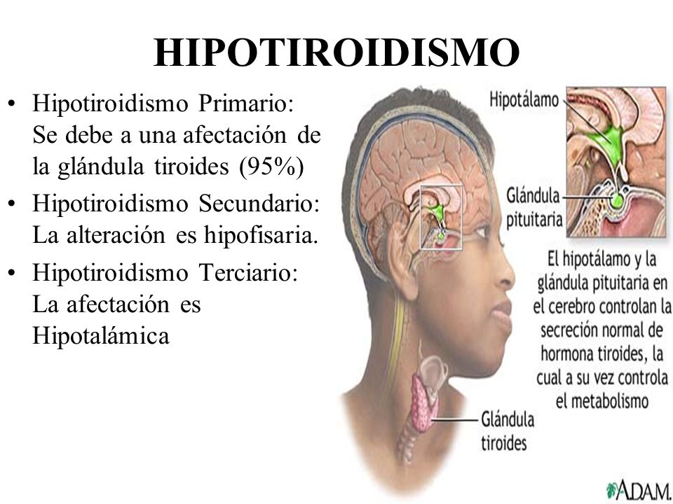 HIPOTIROIDISMO Hipotiroidismo Primario: Se debe a una afectación de la glándula tiroides (95%)