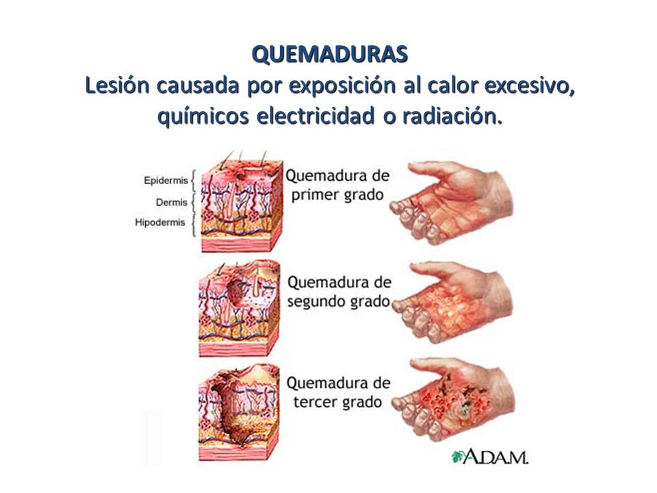 QUEMADURAS Lesión causada por exposición al calor excesivo, químicos electricidad o radiación.