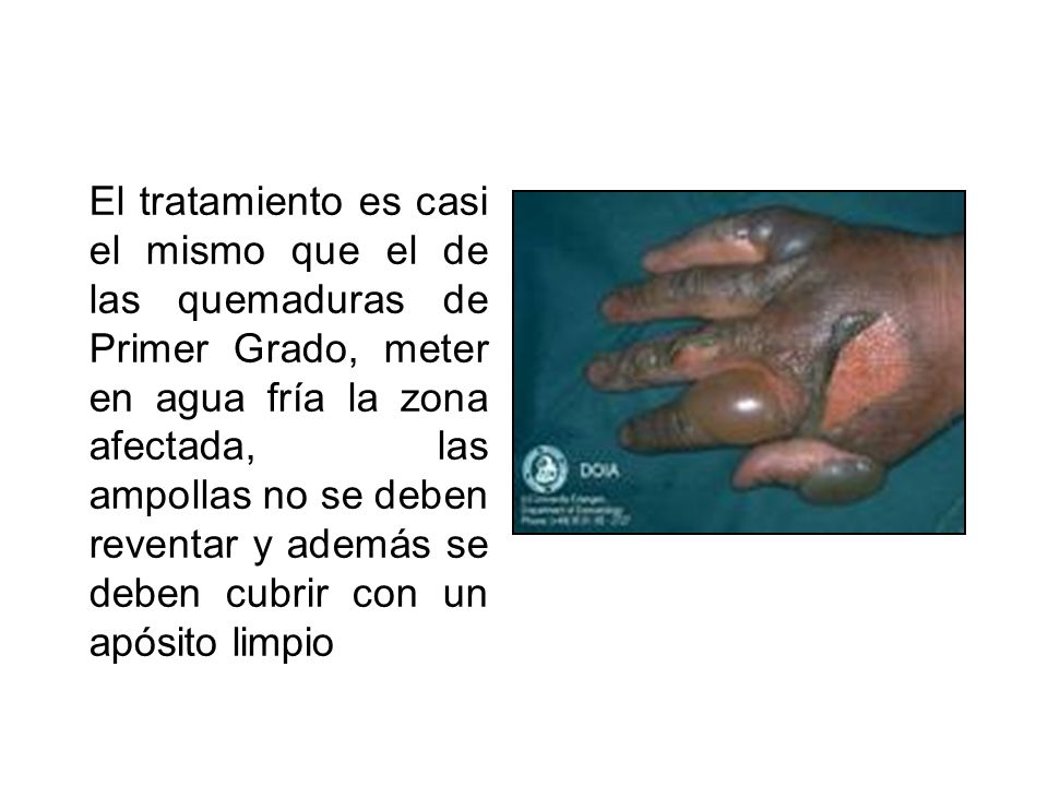 El tratamiento es casi el mismo que el de las quemaduras de Primer Grado, meter en agua fría la zona afectada, las ampollas no se deben reventar y además se deben cubrir con un apósito limpio