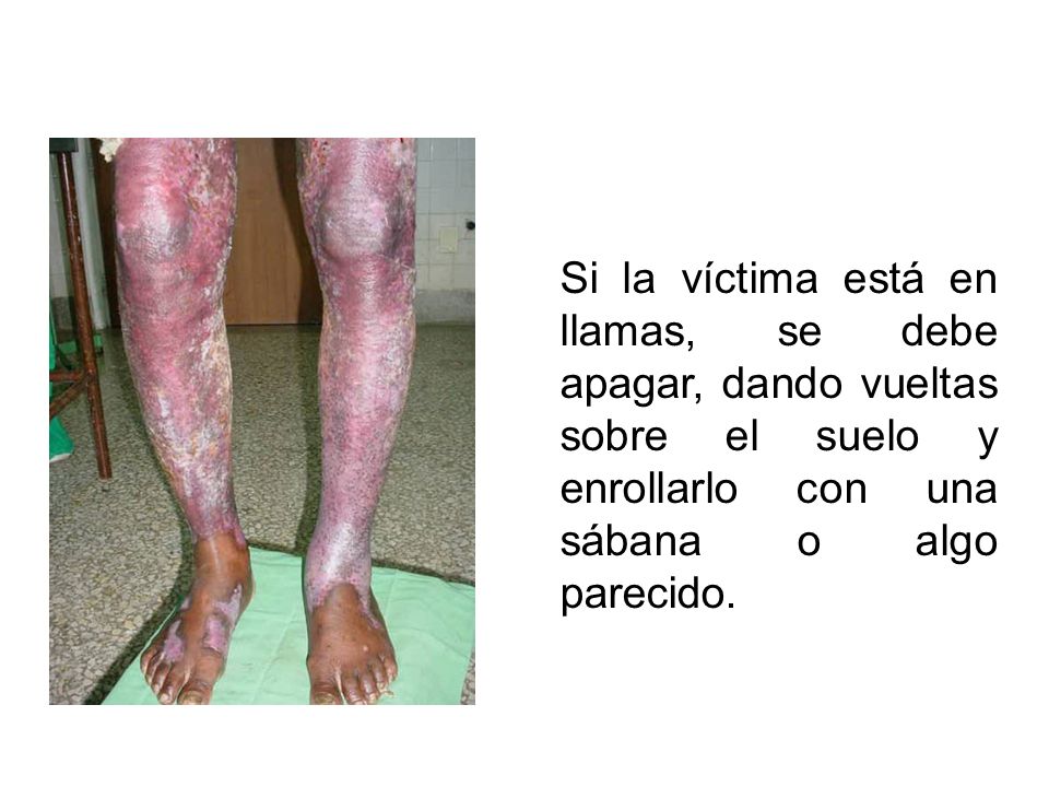 Si la víctima está en llamas, se debe apagar, dando vueltas sobre el suelo y enrollarlo con una sábana o algo parecido.
