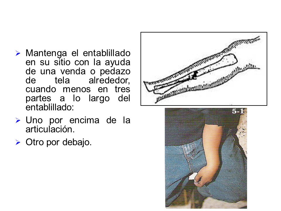 Mantenga el entablillado en su sitio con la ayuda de una venda o pedazo de tela alrededor, cuando menos en tres partes a lo largo del entablillado: