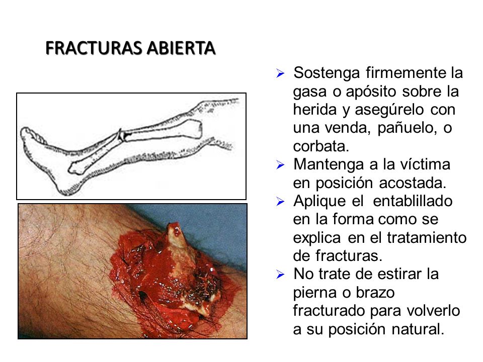 FRACTURAS ABIERTA Sostenga firmemente la gasa o apósito sobre la