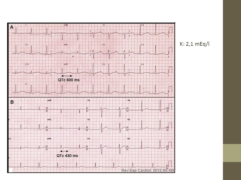 K: 2,1 mEq/l QTc normal en varones: <450 ms