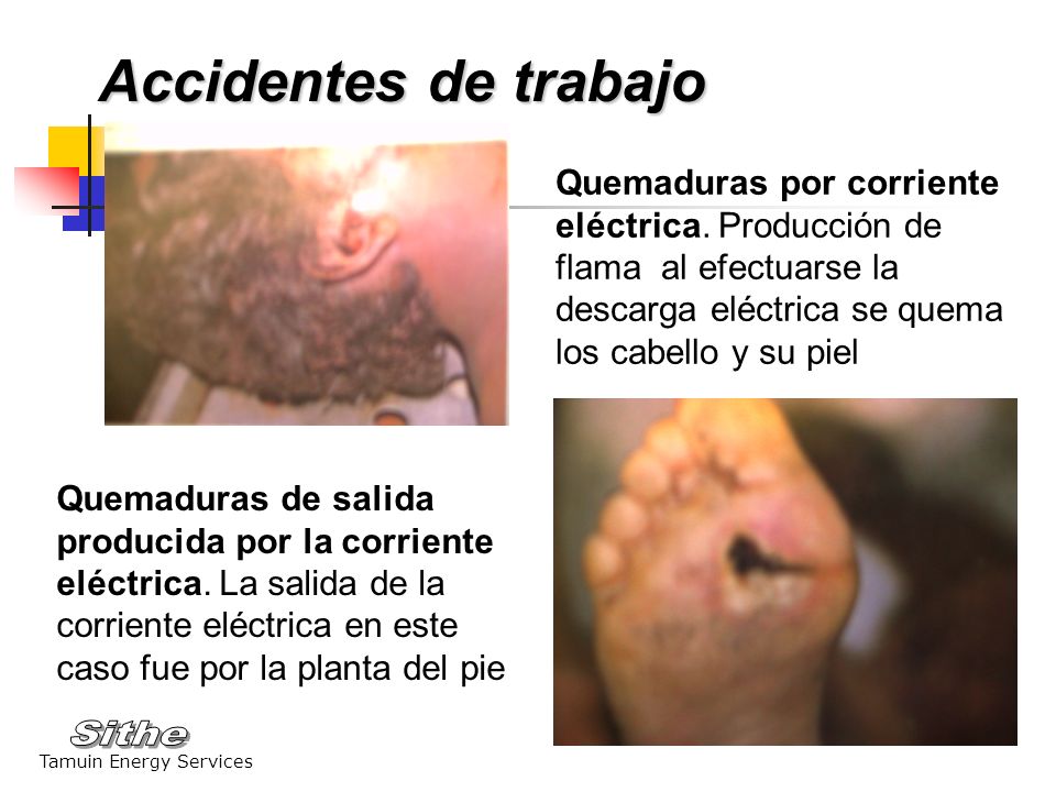 Accidentes de trabajo Quemaduras por corriente eléctrica. Producción de flama al efectuarse la descarga eléctrica se quema los cabello y su piel.