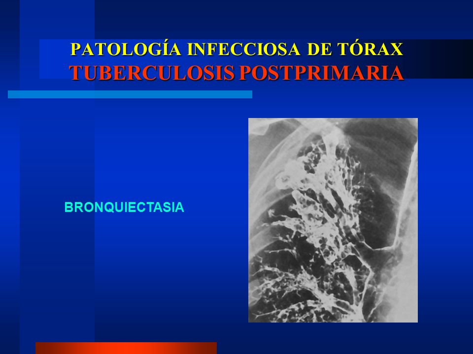 PATOLOGÍA INFECCIOSA DE TÓRAX TUBERCULOSIS POSTPRIMARIA