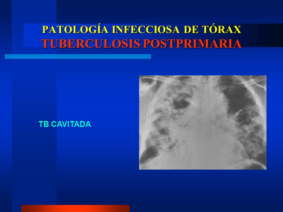 PATOLOGÍA INFECCIOSA DE TÓRAX TUBERCULOSIS POSTPRIMARIA