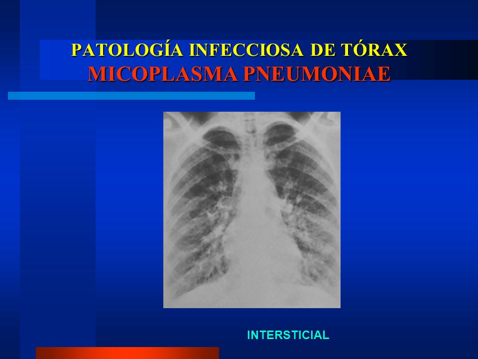 PATOLOGÍA INFECCIOSA DE TÓRAX MICOPLASMA PNEUMONIAE