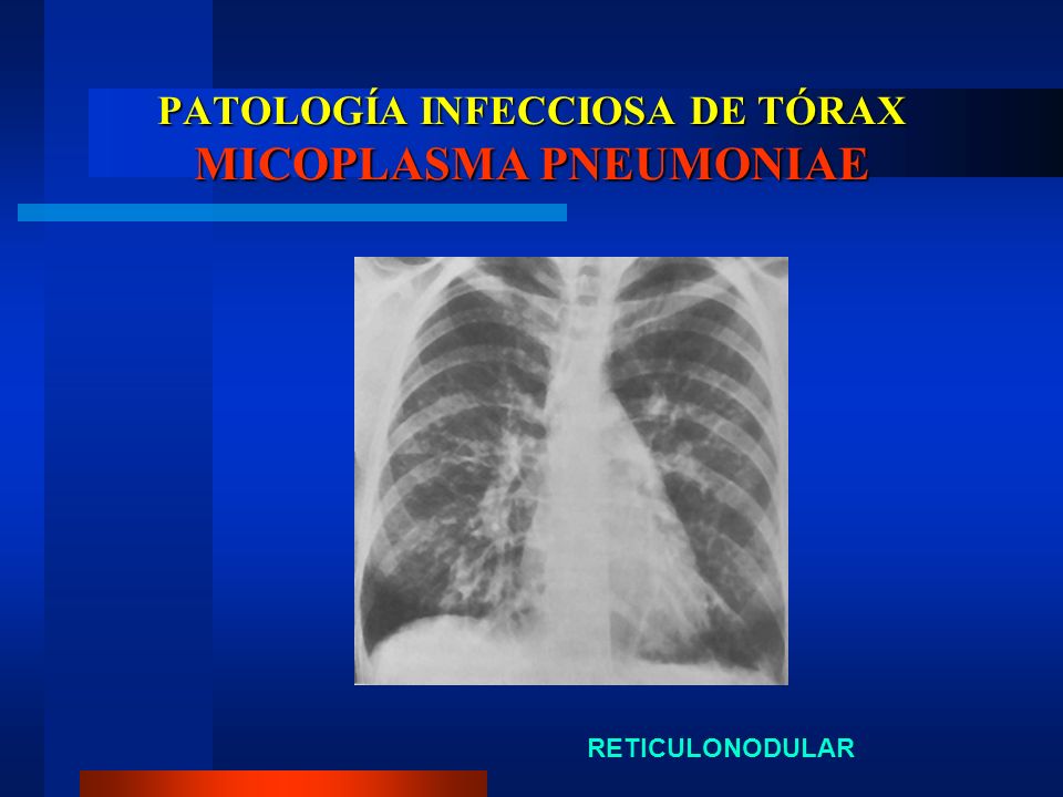 PATOLOGÍA INFECCIOSA DE TÓRAX MICOPLASMA PNEUMONIAE
