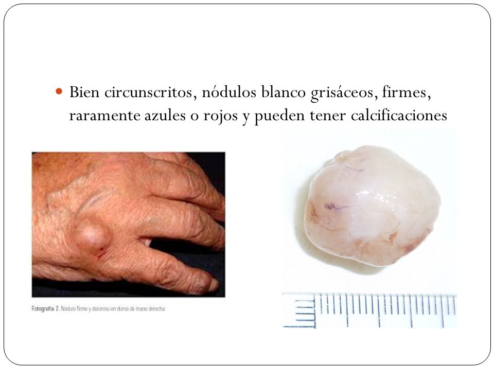 Bien circunscritos, nódulos blanco grisáceos, firmes, raramente azules o rojos y pueden tener calcificaciones