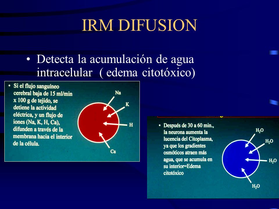 IRM DIFUSION Detecta la acumulación de agua intracelular ( edema citotóxico)