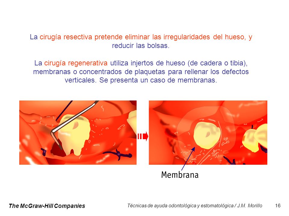 La cirugía resectiva pretende eliminar las irregularidades del hueso, y reducir las bolsas.