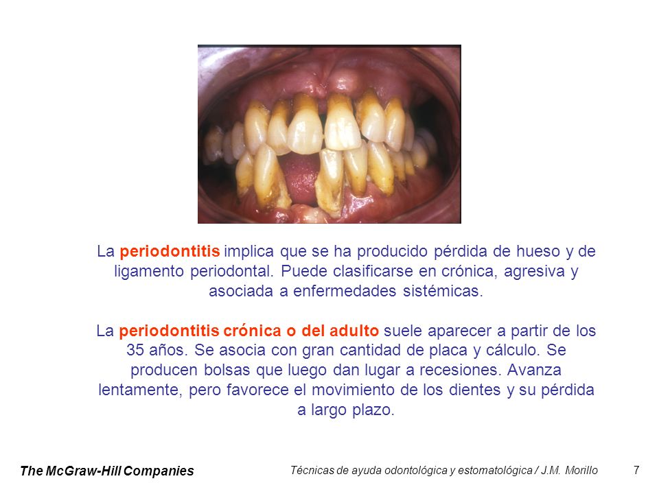 La periodontitis implica que se ha producido pérdida de hueso y de ligamento periodontal. Puede clasificarse en crónica, agresiva y asociada a enfermedades sistémicas.
