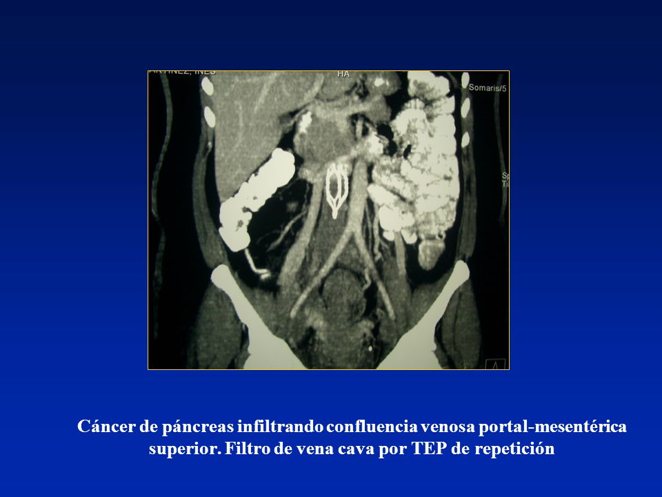 Cáncer de páncreas infiltrando confluencia venosa portal-mesentérica superior.
