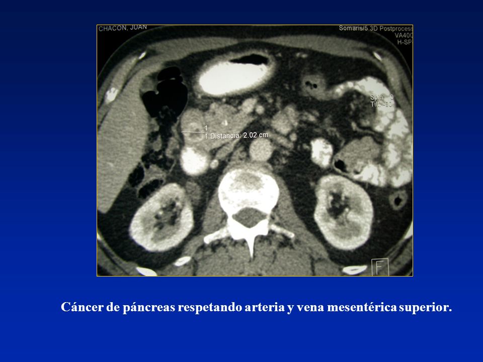 Cáncer de páncreas respetando arteria y vena mesentérica superior.