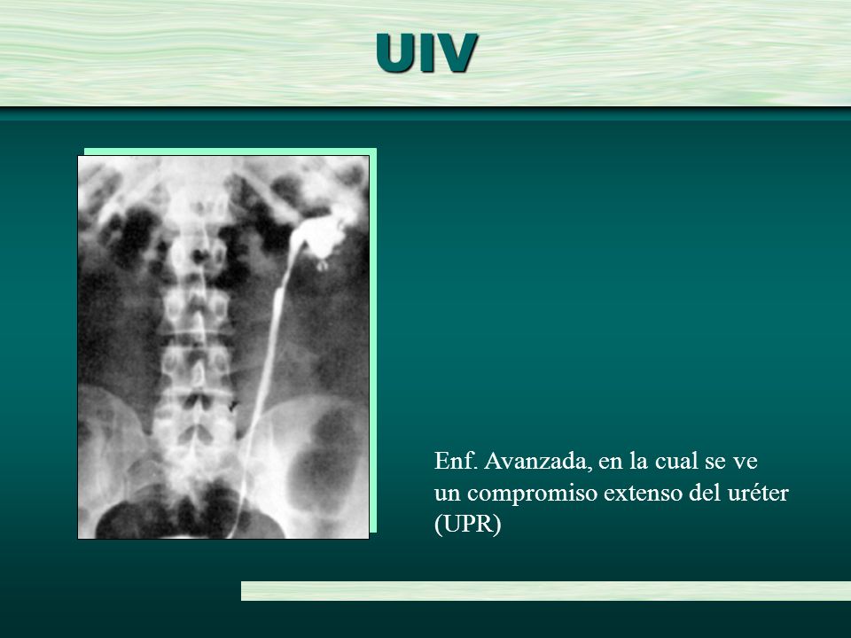 UIV Enf. Avanzada, en la cual se ve un compromiso extenso del uréter