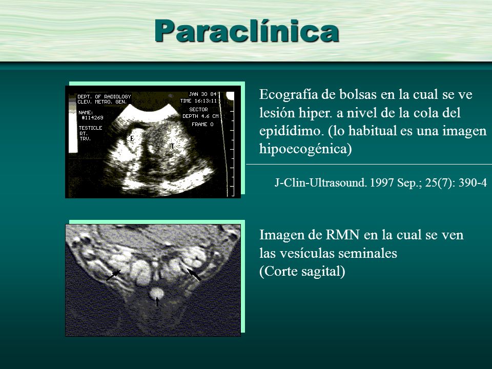 Paraclínica Ecografía de bolsas en la cual se ve lesión hiper. a nivel de la cola del epidídimo. (lo habitual es una imagen hipoecogénica)