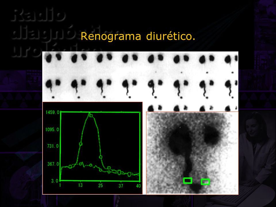 Renograma diurético. Aquí tenemos un renograma diurético en un paciente con megaureter izquierdo.