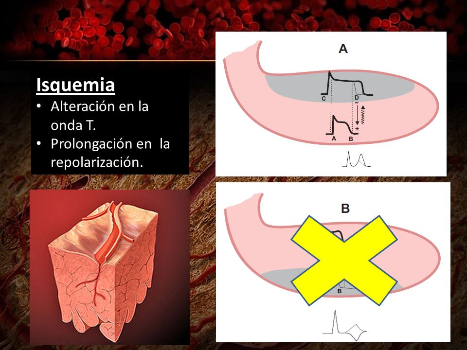 Isquemia Alteración en la onda T. Prolongación en la repolarización.