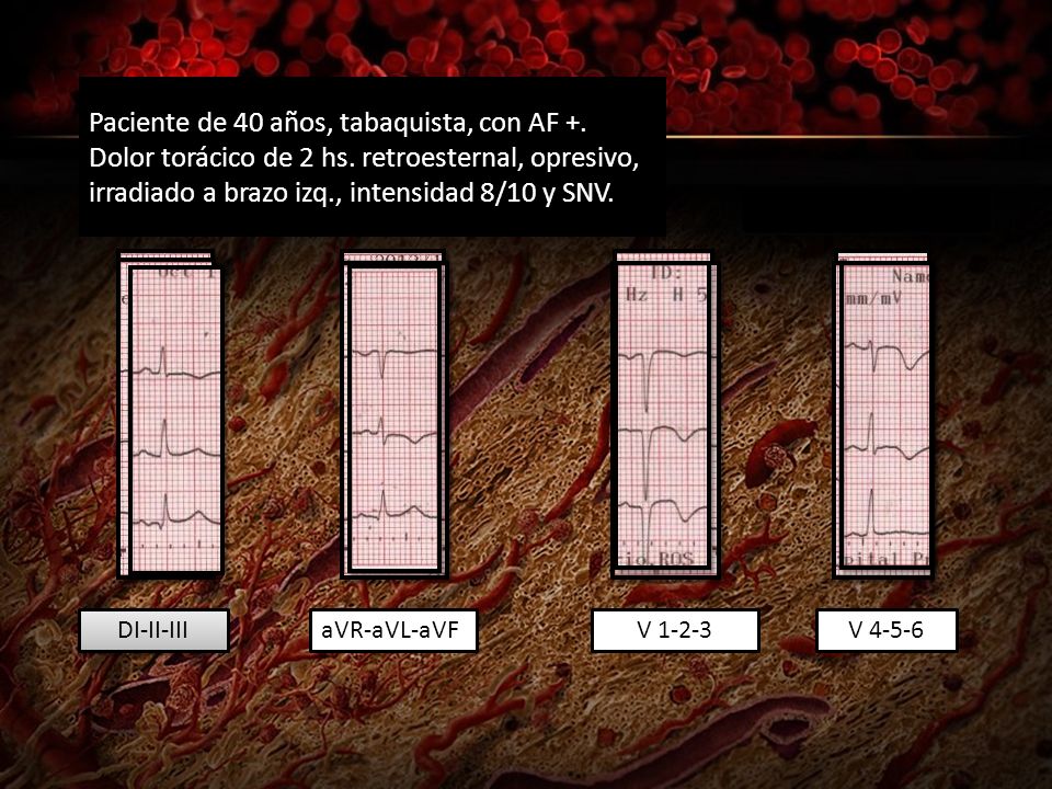 Paciente de 40 años, tabaquista, con AF +. Dolor torácico de 2 hs