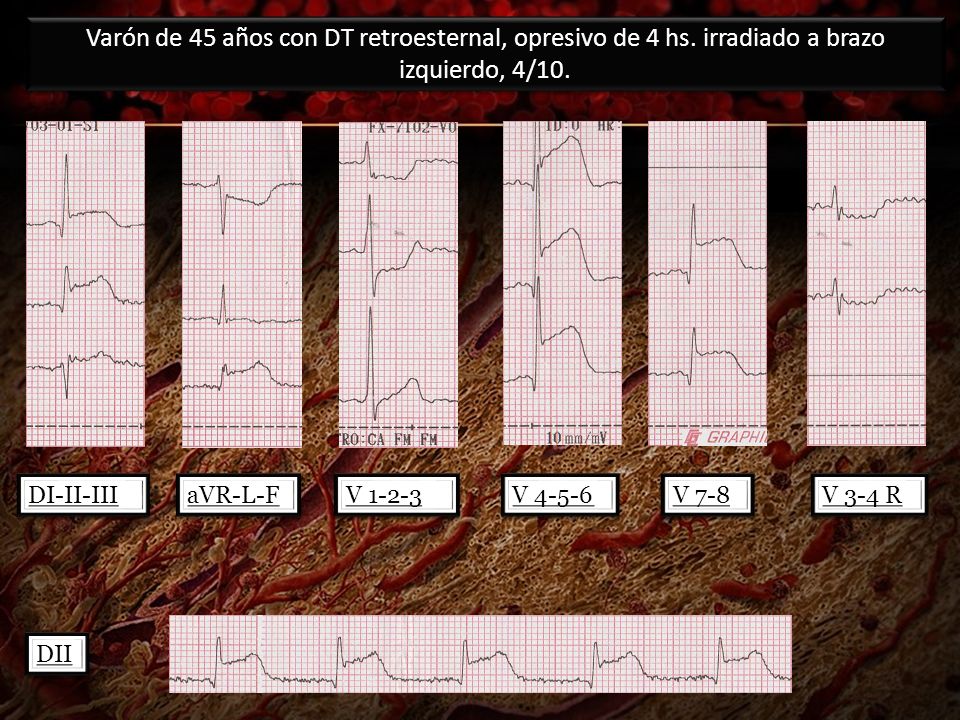 Varón de 45 años con DT retroesternal, opresivo de 4 hs