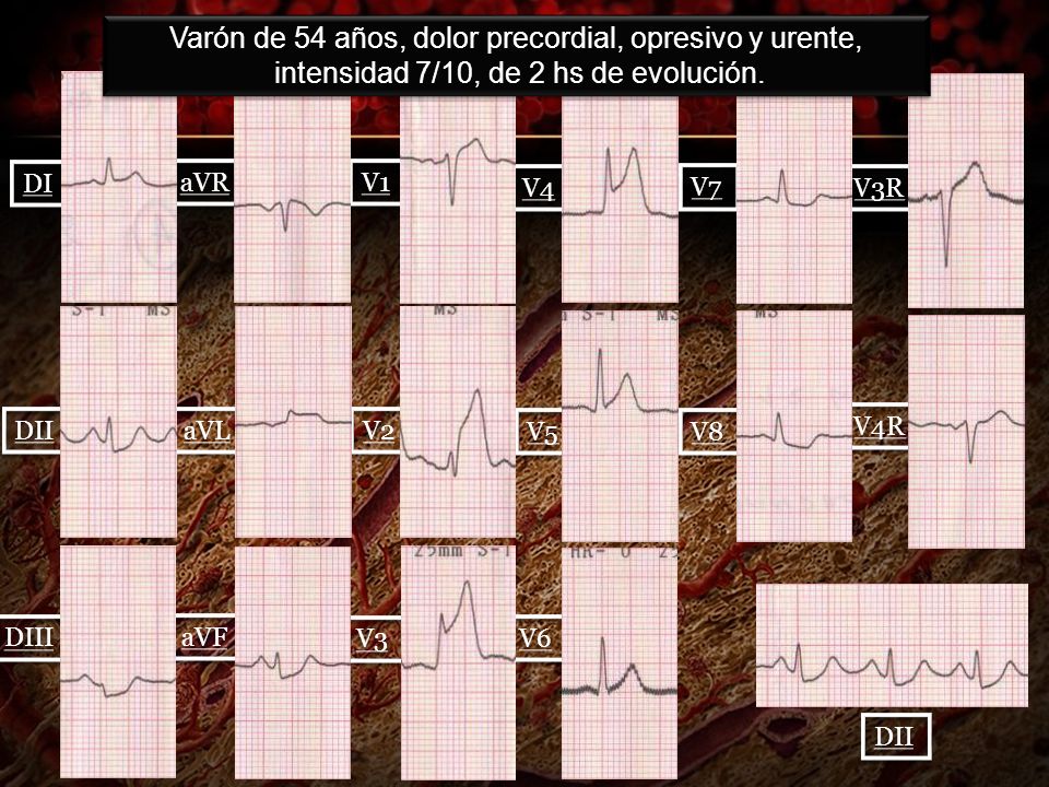 Varón de 54 años, dolor precordial, opresivo y urente,