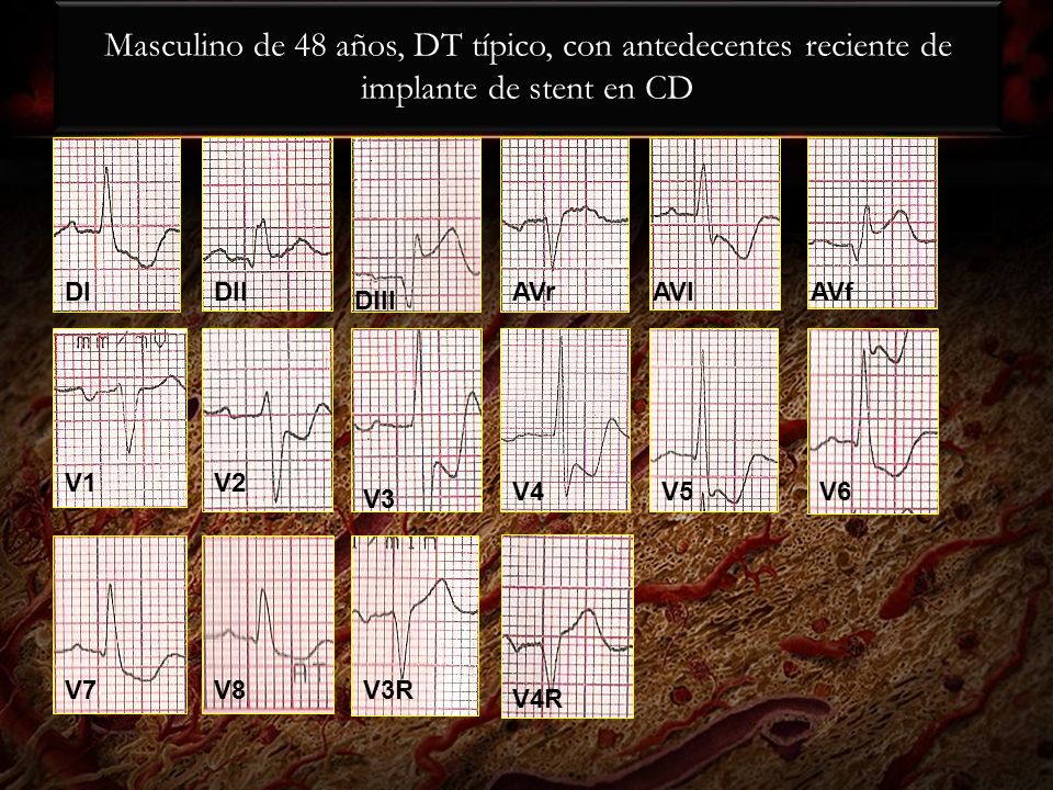 Masculino de 48 años, DT típico, con antedecentes reciente de implante de stent en CD
