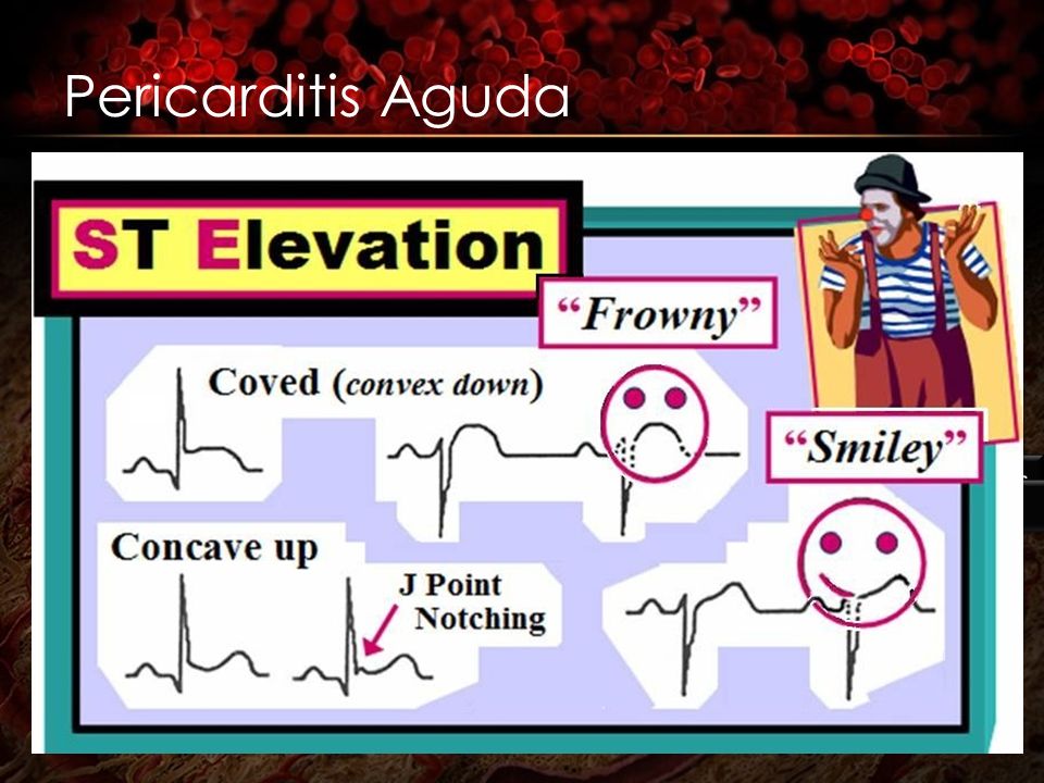 Pericarditis Aguda Presentación clínica (dolor tipo puntada, exacerba con movimientos e inspiración, etc.)