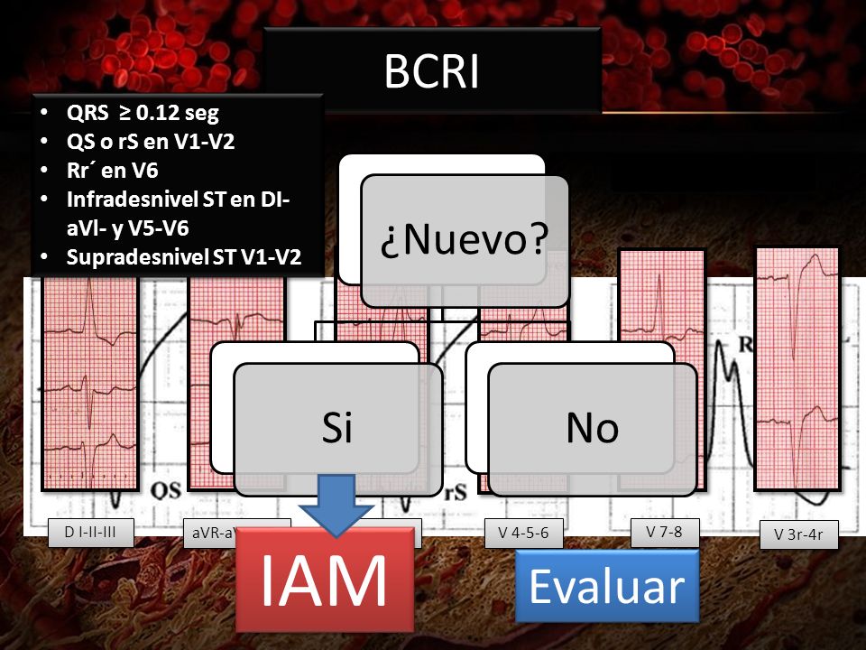 IAM BCRI Evaluar QRS ≥ 0.12 seg QS o rS en V1-V2 Rr´ en V6