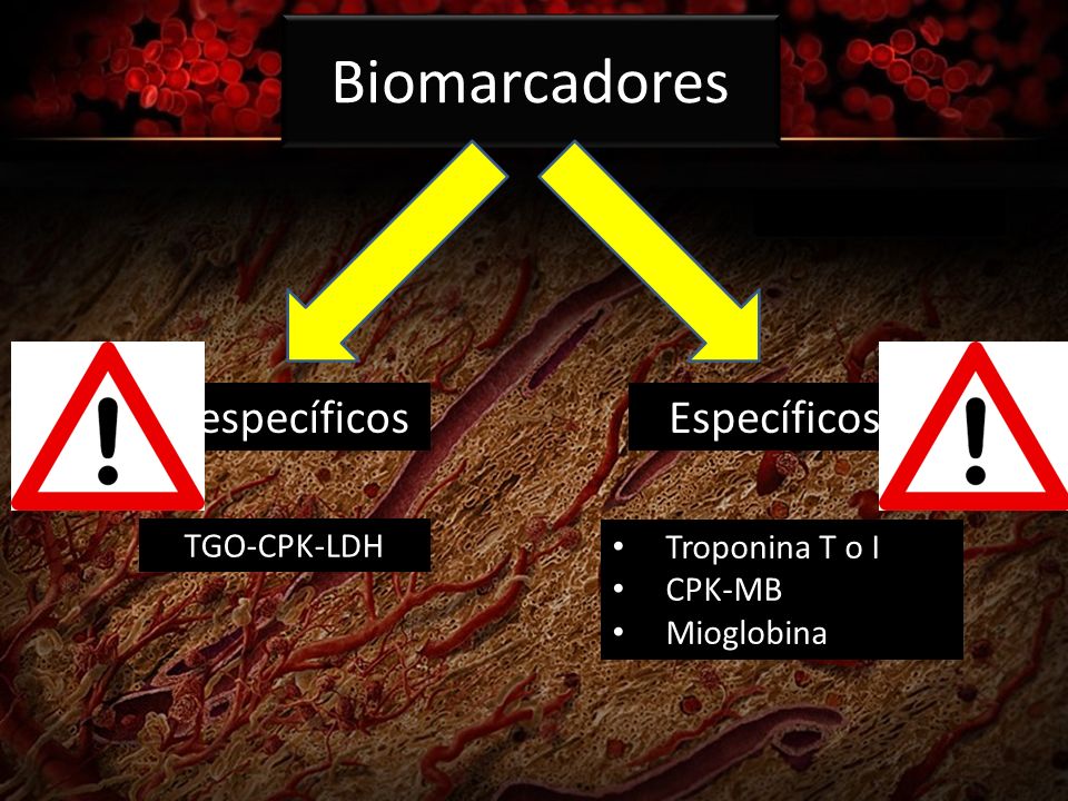 Biomarcadores Inespecíficos Específicos TGO-CPK-LDH Troponina T o I