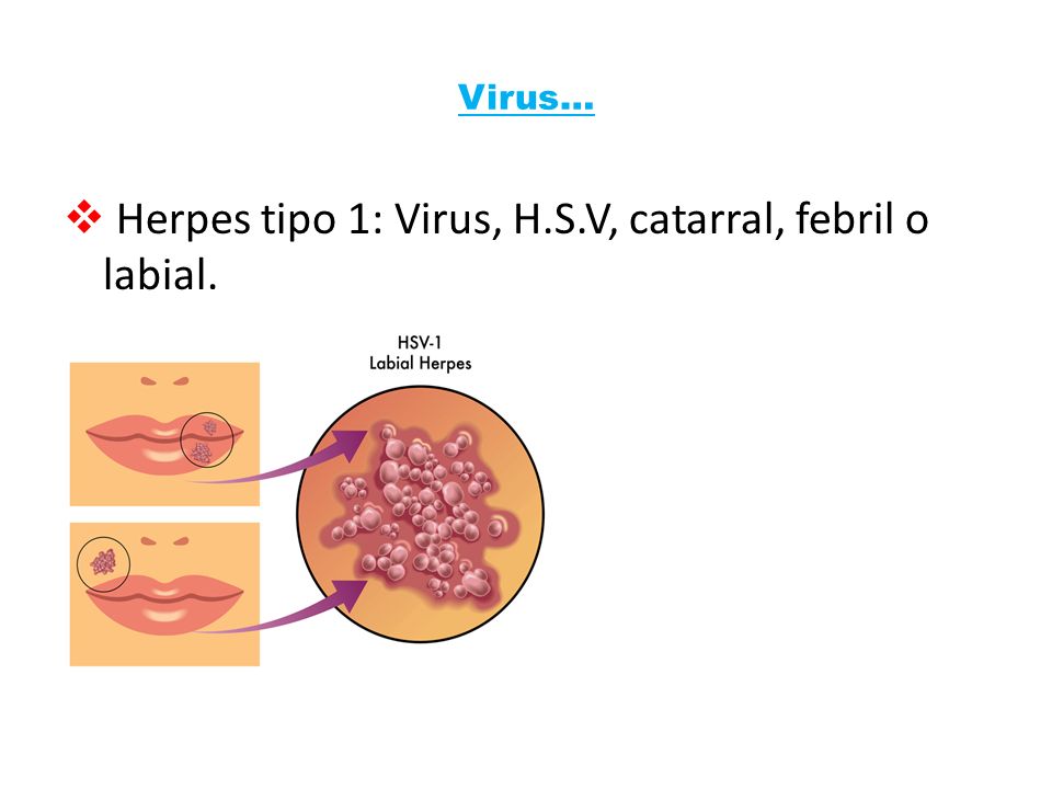 Herpes tipo 1: Virus, H.S.V, catarral, febril o labial.