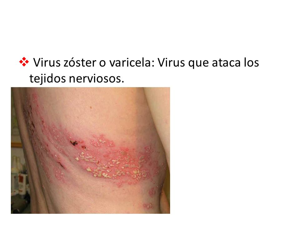 Virus zóster o varicela: Virus que ataca los tejidos nerviosos.