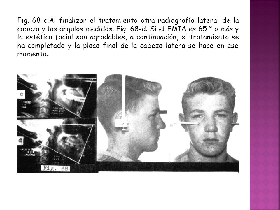 Fig. 68-c.Al finalizar el tratamiento otra radiografía lateral de la cabeza y los ángulos medidos.
