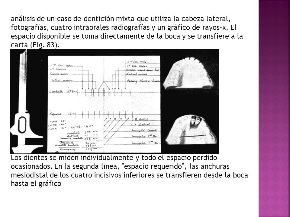 análisis de un caso de dentición mixta que utiliza la cabeza lateral, fotografías, cuatro intraorales radiografías y un gráfico de rayos-x. El espacio disponible se toma directamente de la boca y se transfiere a la carta (Fig. 83).