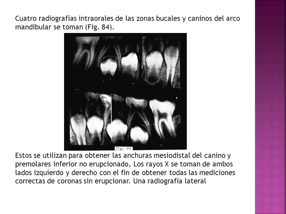 Cuatro radiografías intraorales de las zonas bucales y caninos del arco mandibular se toman (Fig. 84).