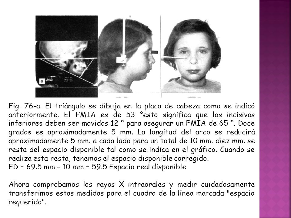 Fig. 76-a. El triángulo se dibuja en la placa de cabeza como se indicó anteriormente. El FMIA es de 53 °esto significa que los incisivos inferiores deben ser movidos 12 ° para asegurar un FMIA de 65 °. Doce grados es aproximadamente 5 mm. La longitud del arco se reducirá aproximadamente 5 mm. a cada lado para un total de 10 mm. diez mm. se resta del espacio disponible tal como se indica en el gráfico. Cuando se realiza esta resta, tenemos el espacio disponible corregido.